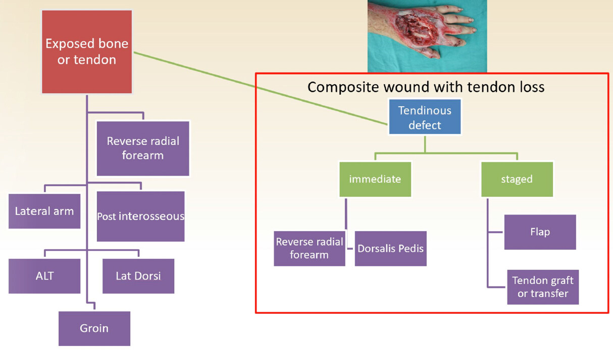 Review of the optimal timing and technique for extensor tendon reconstruction in composite dorsal hand wounds