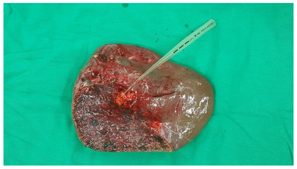 Surgical outcomes of distal splenorenal shunt or liver transplantation in treatment of schistosomal refractory variceal bleeding
