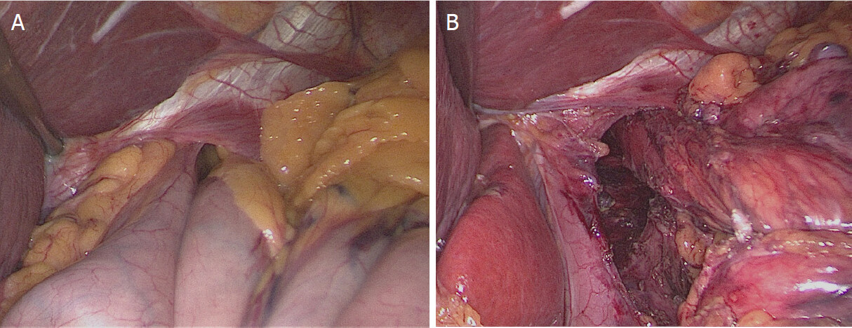 Large hiatal hernia: minimizing early and long-term complications after minimally invasive repair