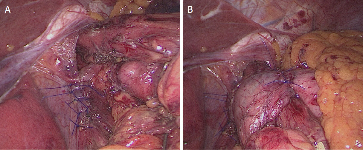 Large hiatal hernia: minimizing early and long-term complications after minimally invasive repair