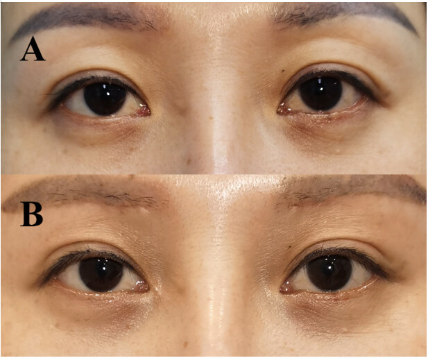 Clinical application of autologous chyle fat transplantation in the correction of sunken upper eyelid