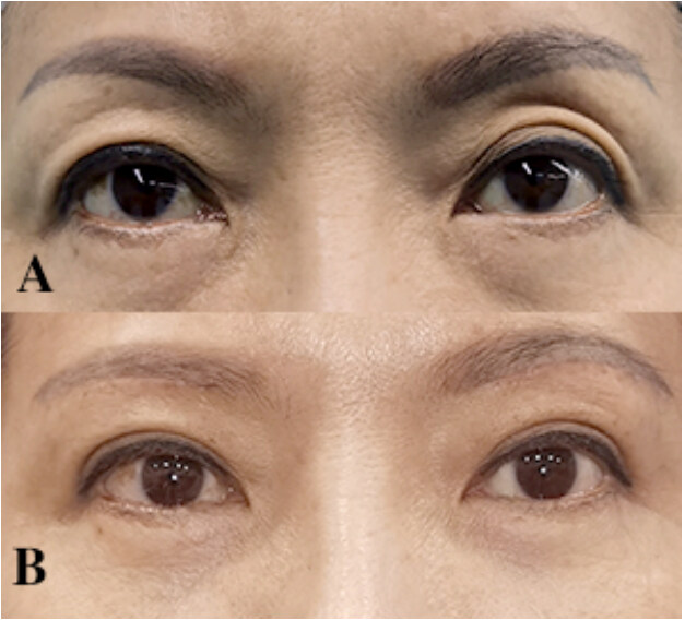 Clinical application of autologous chyle fat transplantation in the correction of sunken upper eyelid