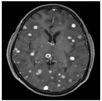 Concurrent occurrence of both intracranial and intramedullary tuberculomas