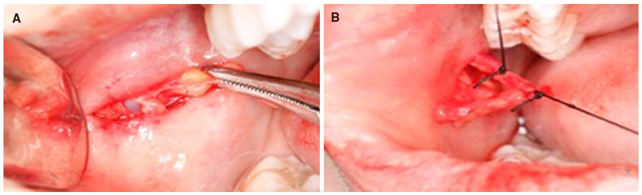 Clinical applications of the jugal lipectomy technique: case reports