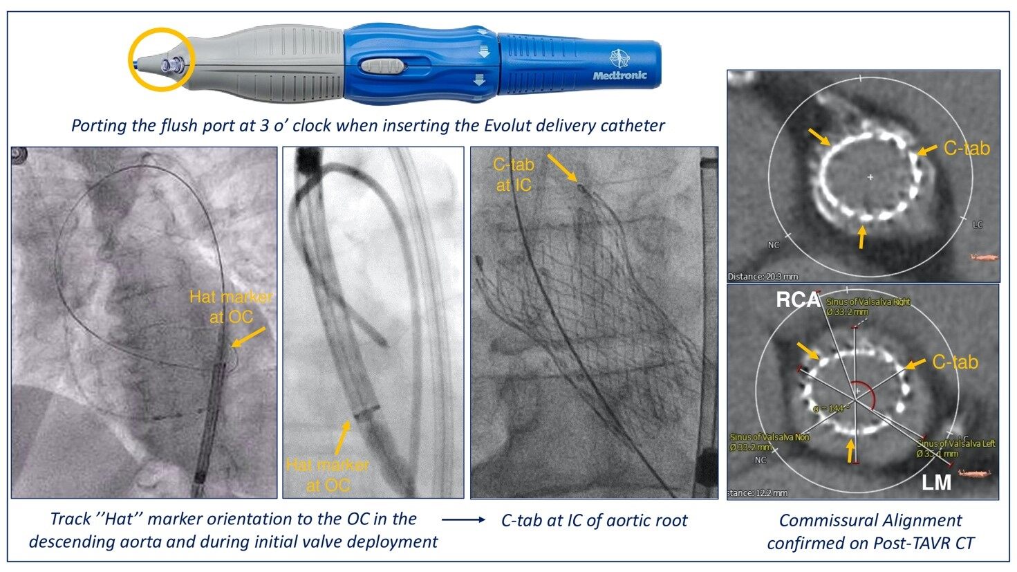 Commissural alignment in TAVI: a new frontier to facilitate coronary reaccess and Redo TAVI