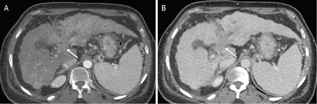 Liver imaging reporting and data system and CT/MRI diagnosis of hepatocellular carcinoma