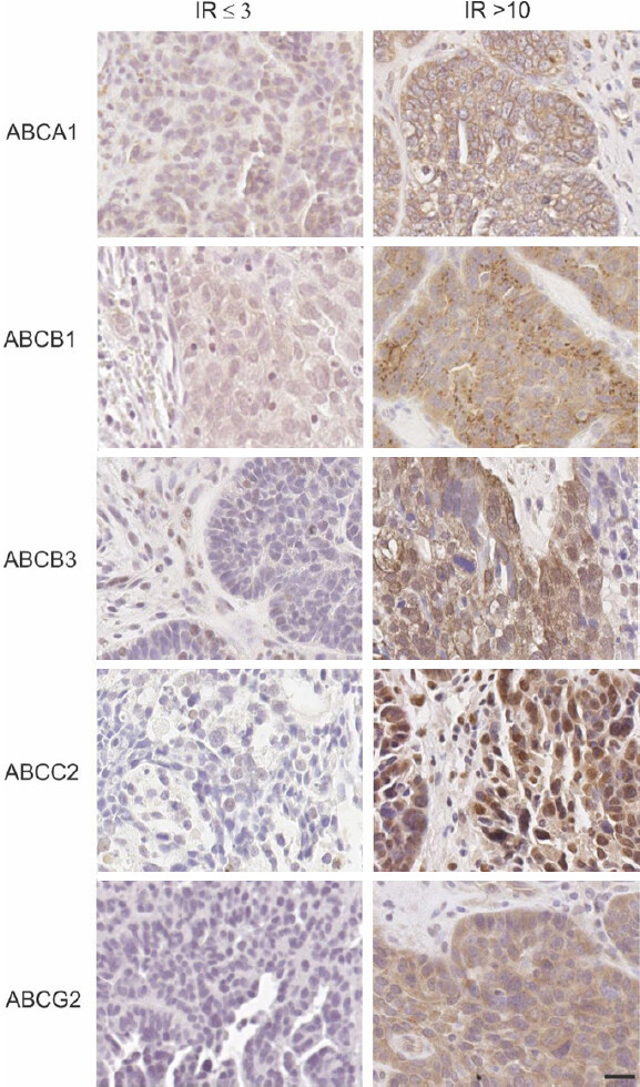ABCA1 is associated with the development of acquired chemotherapy resistance and predicts poor ovarian cancer outcome