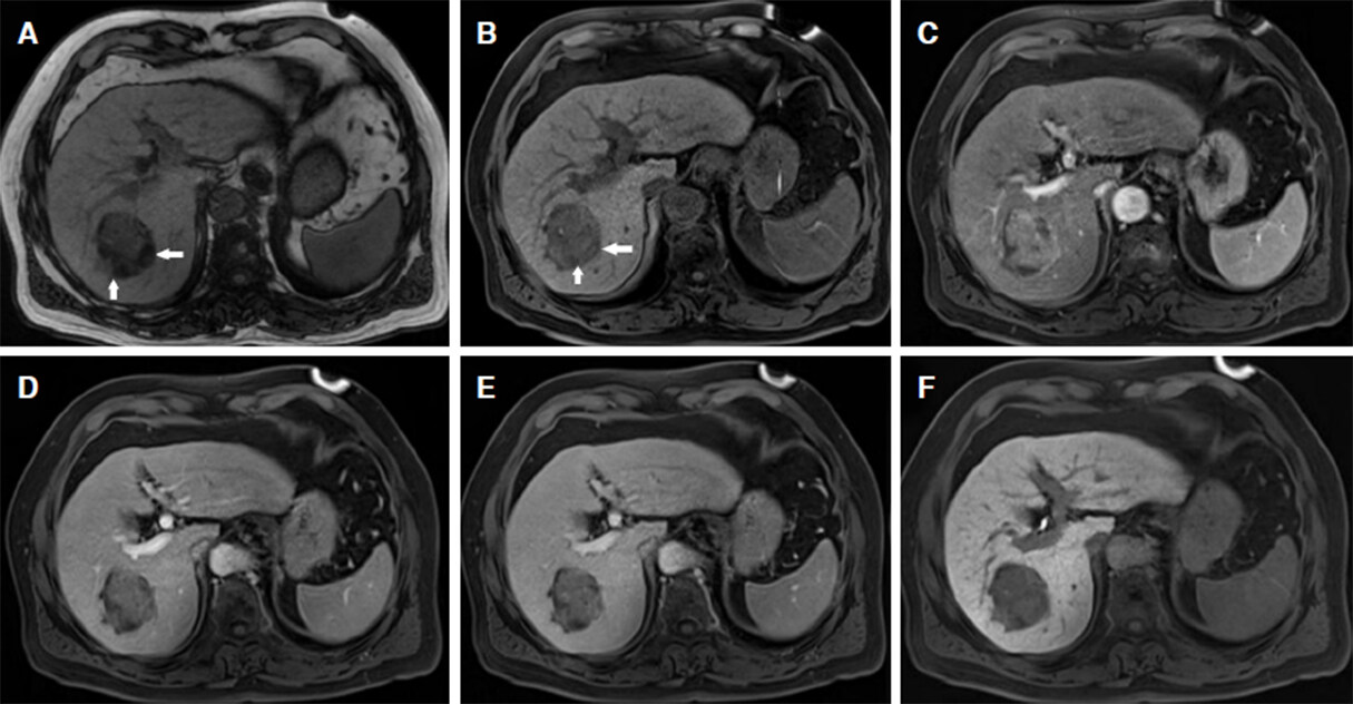 Imaging biomarkers for predicting poor prognosis of hepatocellular carcinoma: a review