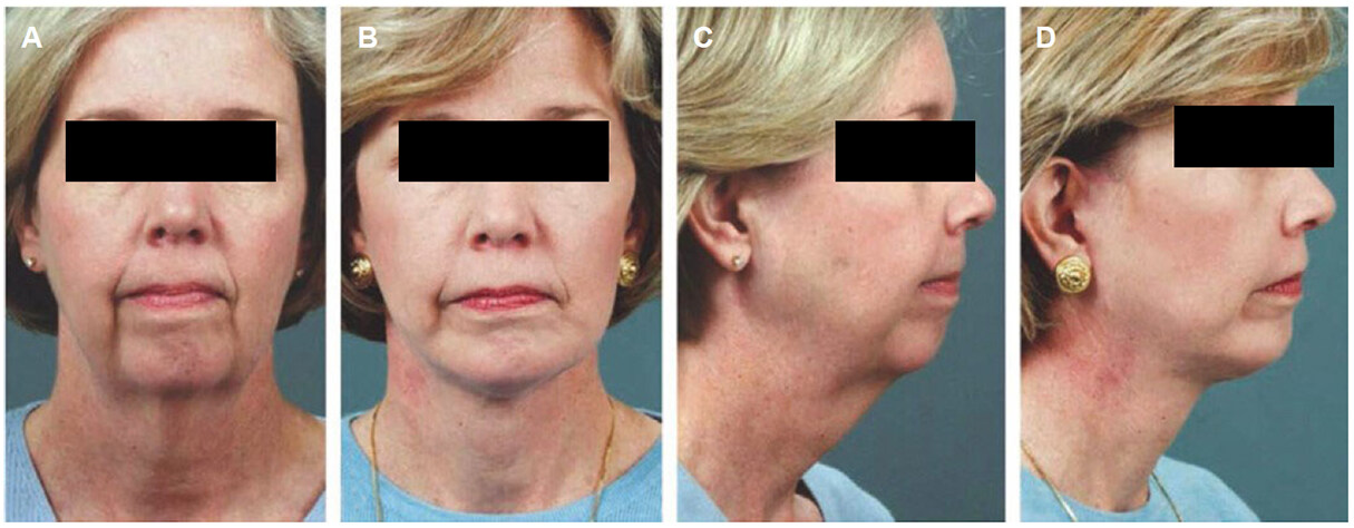 A layered approach to neck lift