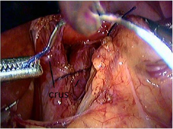 Preoperative workup, patient selection, surgical technique and follow-up for a successful laparoscopic Nissen fundoplication