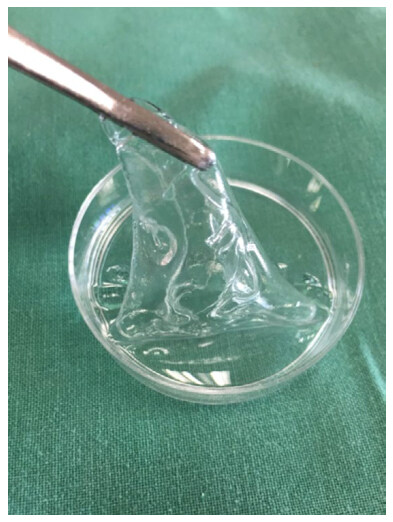 Hyaluronic acid: a versatile biomaterial in tissue engineering