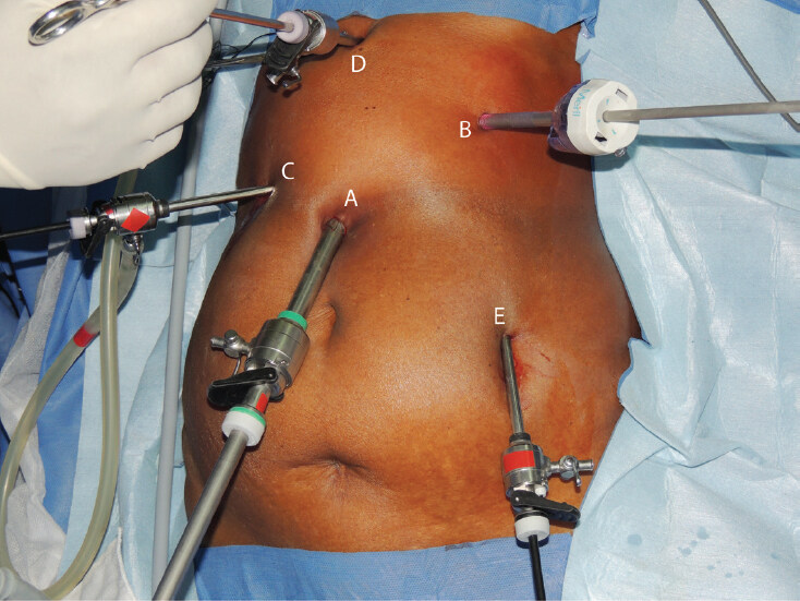 Thoraco-laparoscopic Ivor-Lewis esophagectomy: the most extensive Indian experience