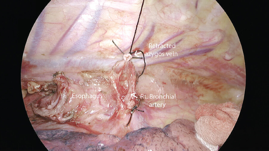 Thoraco-laparoscopic Ivor-Lewis esophagectomy: the most extensive Indian experience
