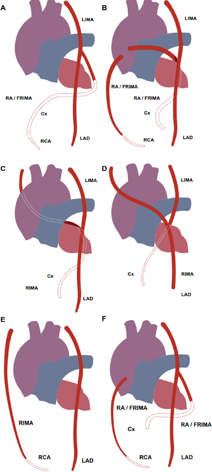 Why and how to achieve total arterial revascularisation in coronary surgery