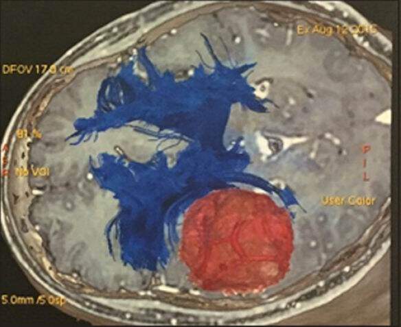 Brain tumor surgery: supplemental intra-operative imaging techniques and future challenges