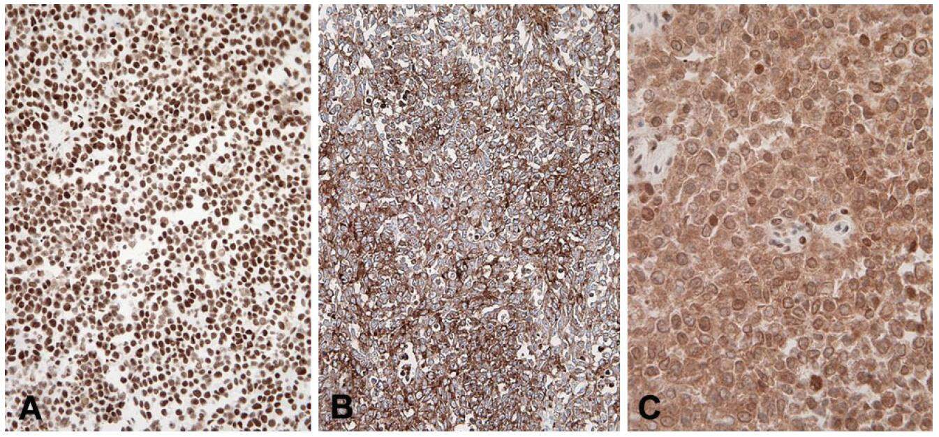 Uterine large cell neuroendocrine carcinoma with unusual colonic metastasis