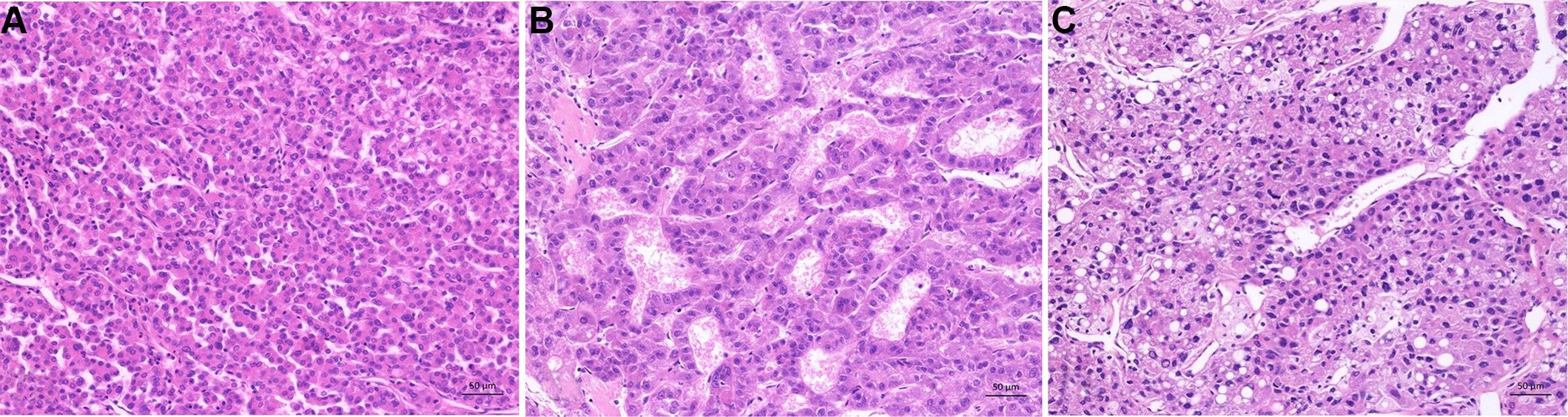 Histopathology of hepatocellular carcinoma - when and what