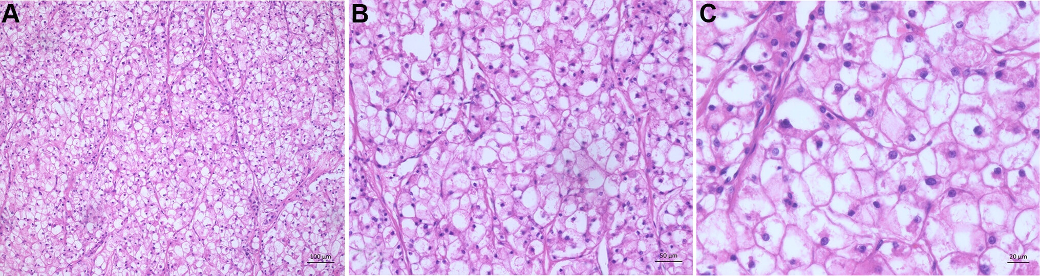 Histopathology of hepatocellular carcinoma - when and what