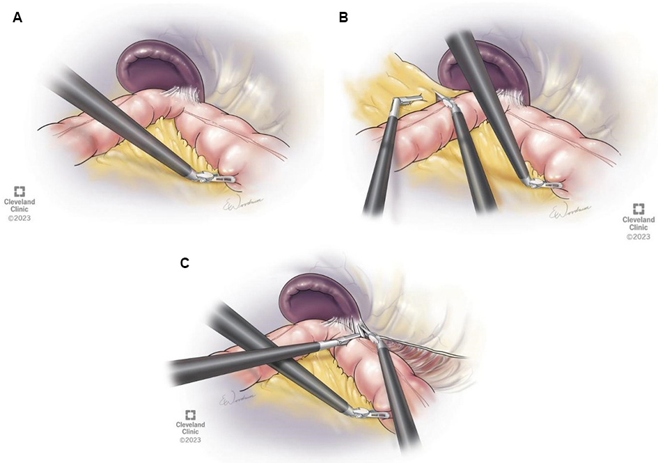 Development of robotic surgical devices and its application in colorectal surgery