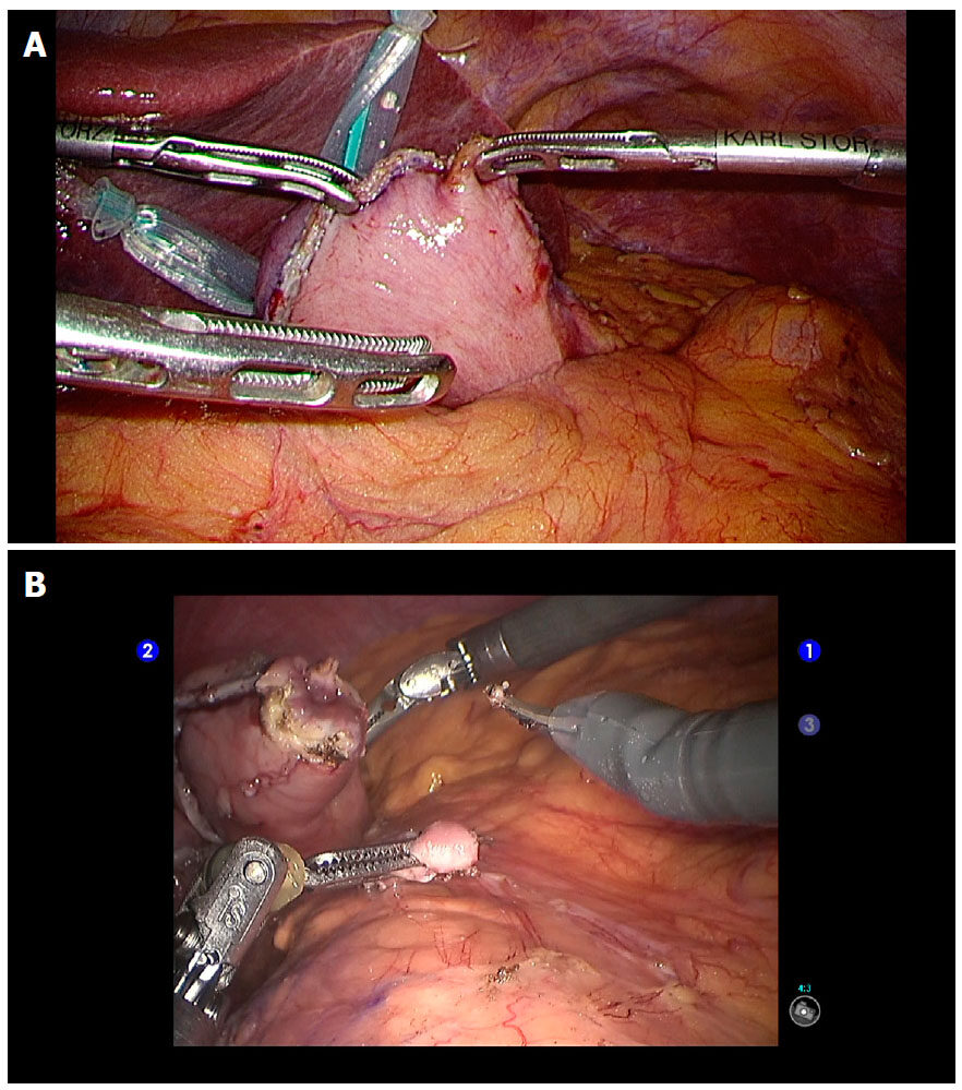Robotic gastrectomy for gastric cancer