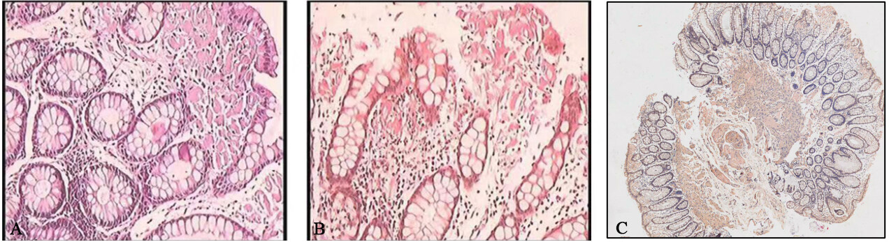 Light chain (AL) amyloidosis following gastrointestinal symptoms that involve multiple organs: a case report