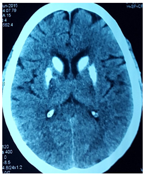 Hypoparathyroidism presenting with late onset seizures - a report of two cases from rural India