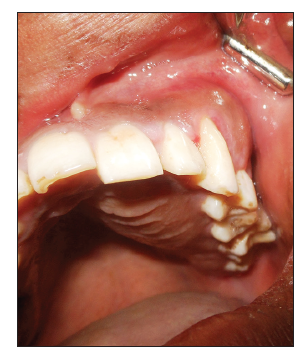 Reconstruction of palate with buccal fat pad secondary to resection of desmoplastic ameloblastoma