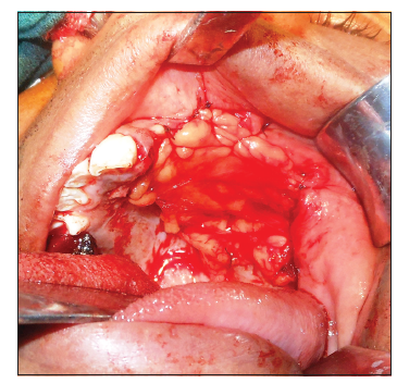 Reconstruction of palate with buccal fat pad secondary to resection of desmoplastic ameloblastoma