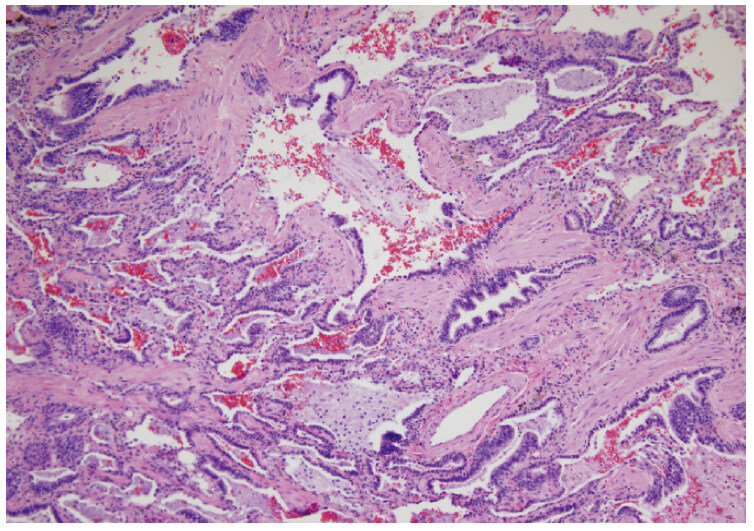 A rare case of delayed chronic pneumonitis following non-medical grade silicone injections in a transgender woman