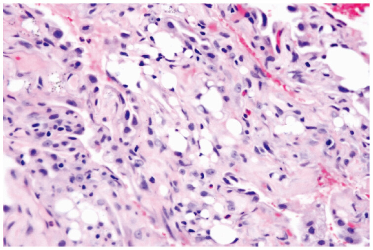 A rare case of delayed chronic pneumonitis following non-medical grade silicone injections in a transgender woman