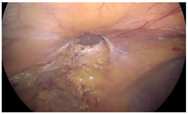 Laparoscopic intra-peritoneal onlay mesh plus repair for ventral abdominal wall hernias - is there substance to the hype?
