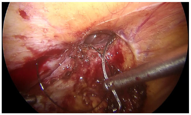 Laparoscopic intra-peritoneal onlay mesh plus repair for ventral abdominal wall hernias - is there substance to the hype?