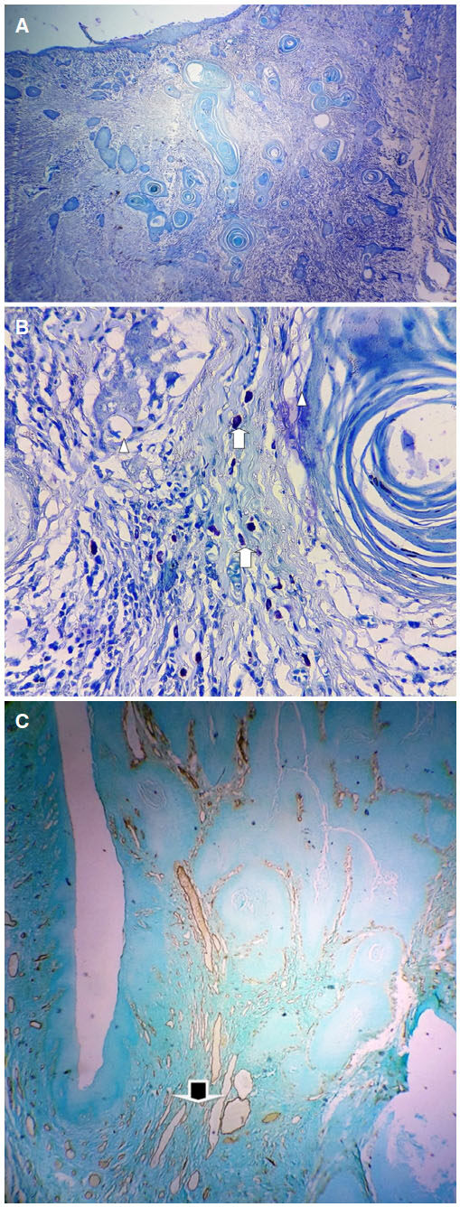 Correlation of elevated mast cell and micro-vessel densities with lymph node metastasis in oral squamous cell carcinoma