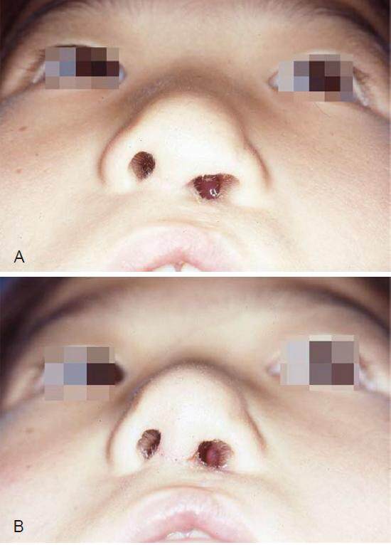 Medially based de-epithelialized flap for nasal base narrowing and nostril sill augmentation in a cleft lip nasal deformity
