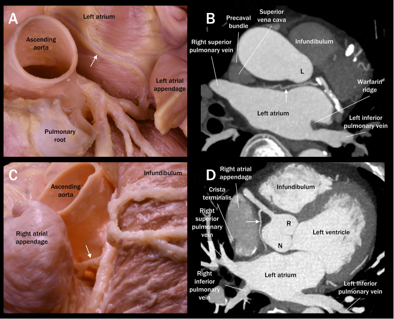 Cardiac blood vessels and irreversible electroporation: findings from pulsed field ablation