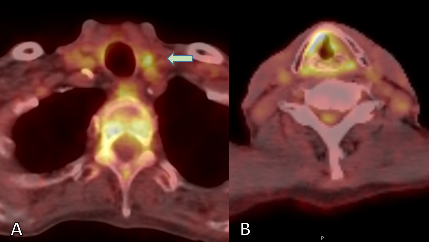 Diagnostic accuracy of MRI and PET/CT for neck staging prior to salvage total laryngectomy