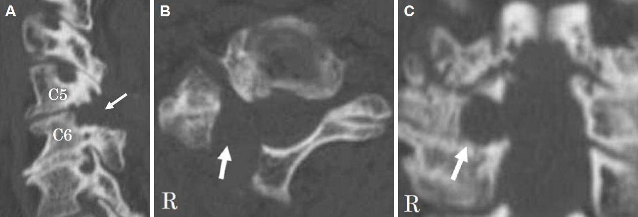 Outcomes of full-endoscopic posterior cervical foraminotomy for cervical radiculopathy caused by bony stenosis of the intervertebral foramen