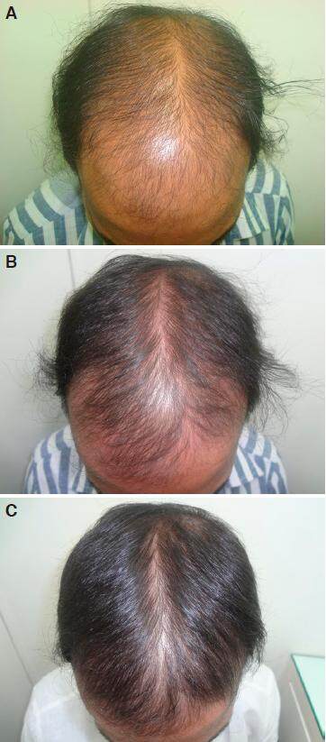 Controlled clinical trial for evaluation of hair growth with low dose cyclical nutrition therapy in men and women without the use of finasteride