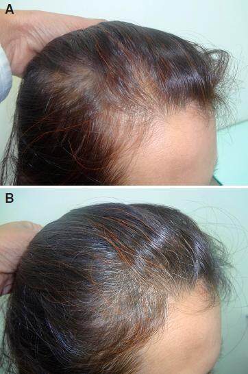 Controlled clinical trial for evaluation of hair growth with low dose cyclical nutrition therapy in men and women without the use of finasteride