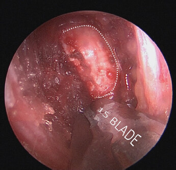 Endoscopic-assisted rib cartilage harvesting for revision rhinoplasty