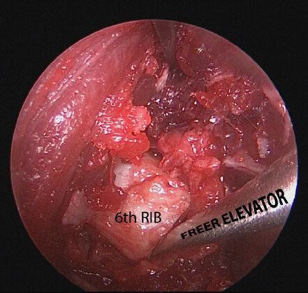 Endoscopic-assisted rib cartilage harvesting for revision rhinoplasty