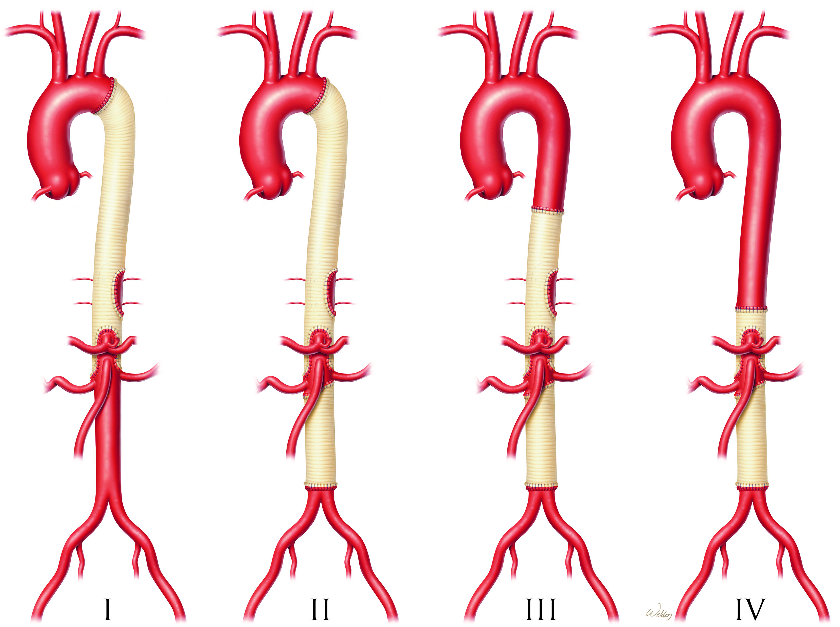 Optimal perioperative care for thoracoabdominal and descending thoracic aortic aneurysm repair: a review