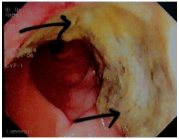 Isolated breast metastasis mimicking as second primary cancer - a case report