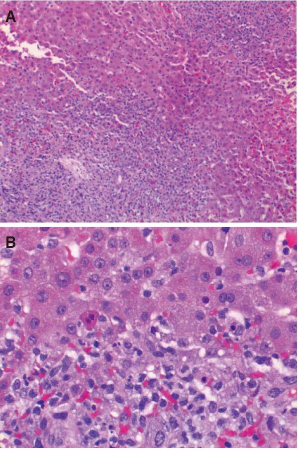 Epstein-Barr virus associated secondary hemophagocytic lymphohistiocytosis with an unusual presentation of abdominal compartment syndrome