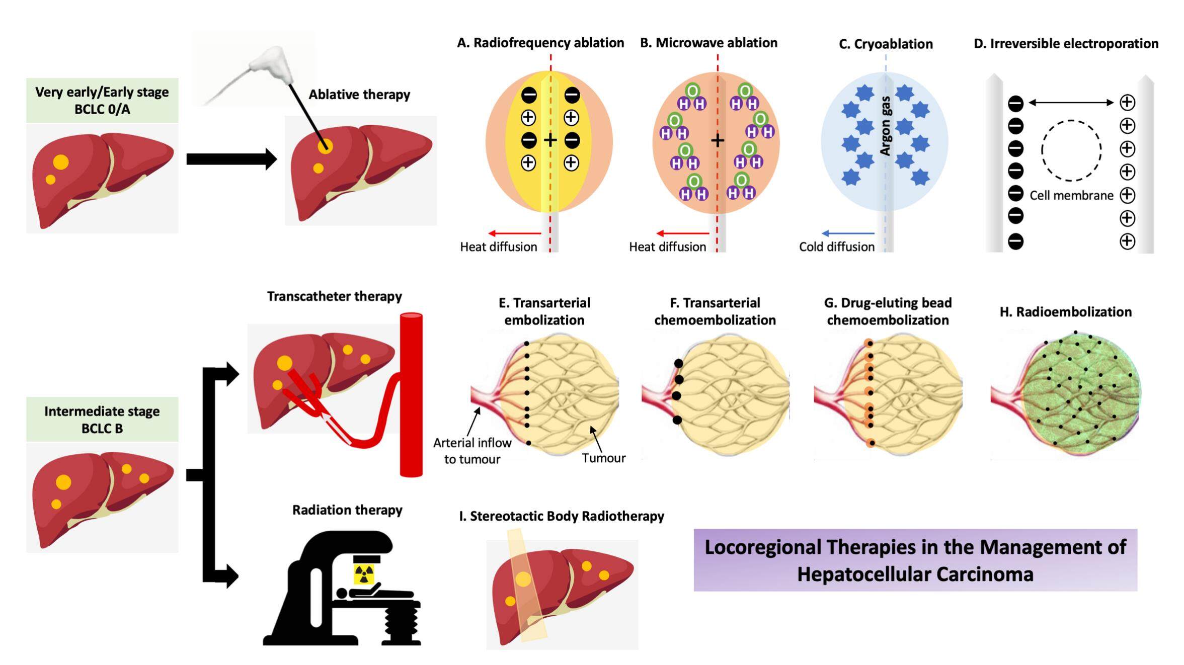 Role of locoregional therapies in the management of patients with hepatocellular carcinoma
