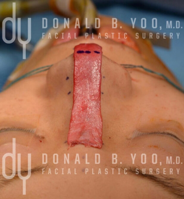 An updated diced cartilage fascia technique for dorsal augmentation in rhinoplasty