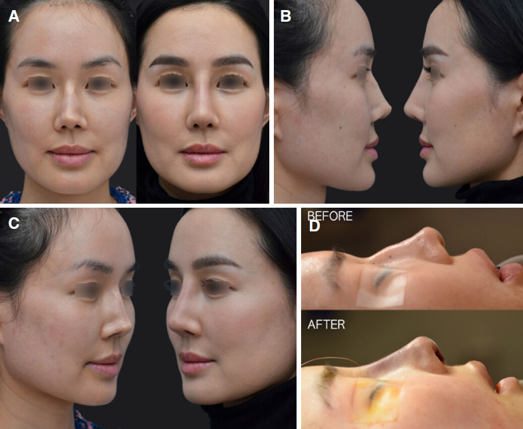 An updated diced cartilage fascia technique for dorsal augmentation in rhinoplasty