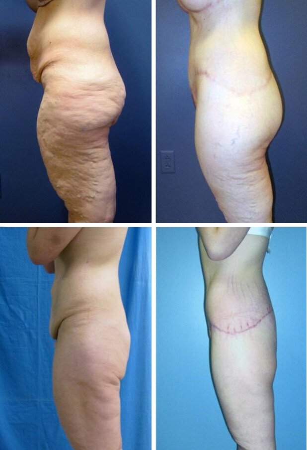 Surgical circumferential contouring: lower body, upper body, and in-between