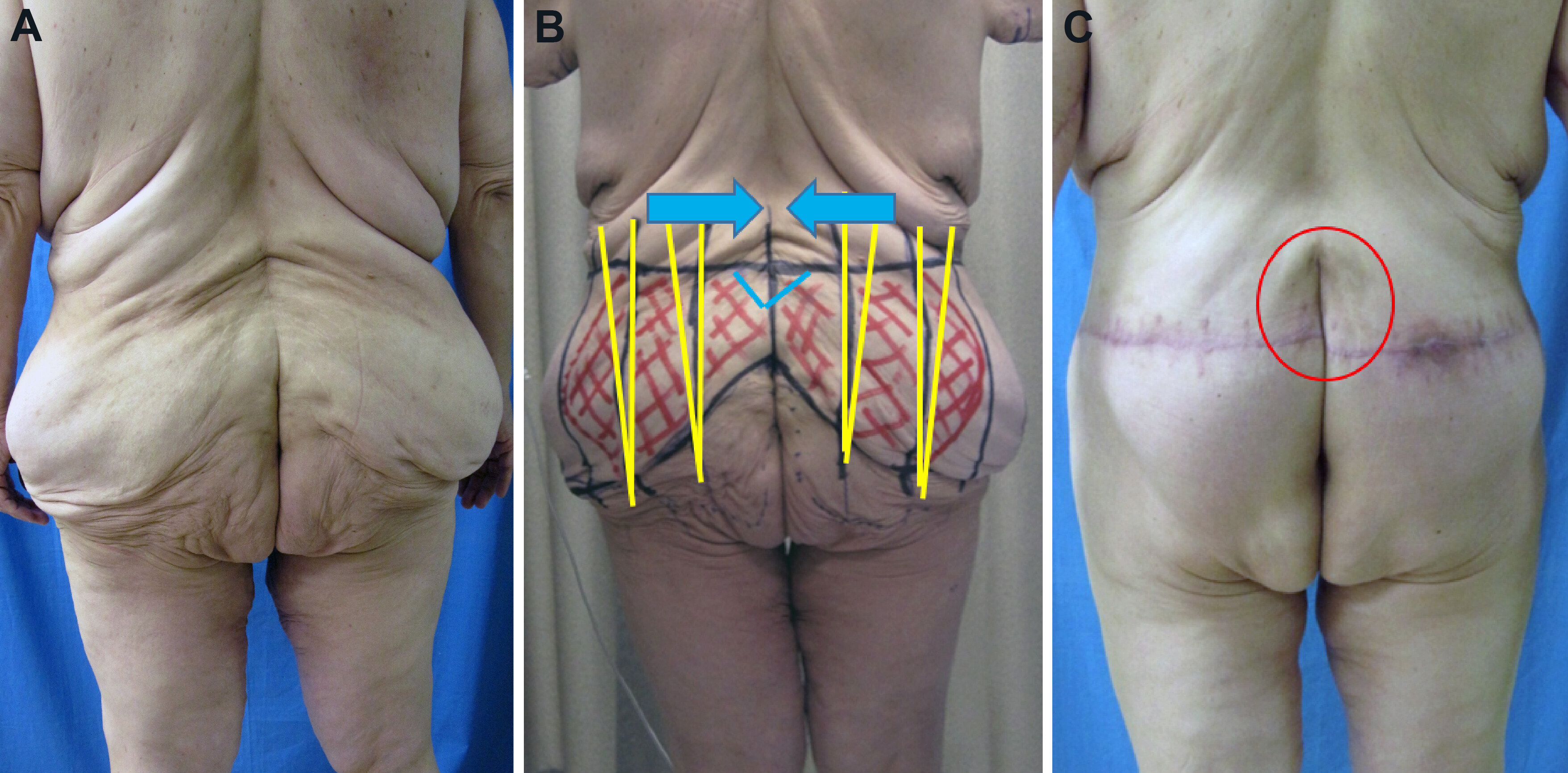 Surgical circumferential contouring: lower body, upper body, and in-between