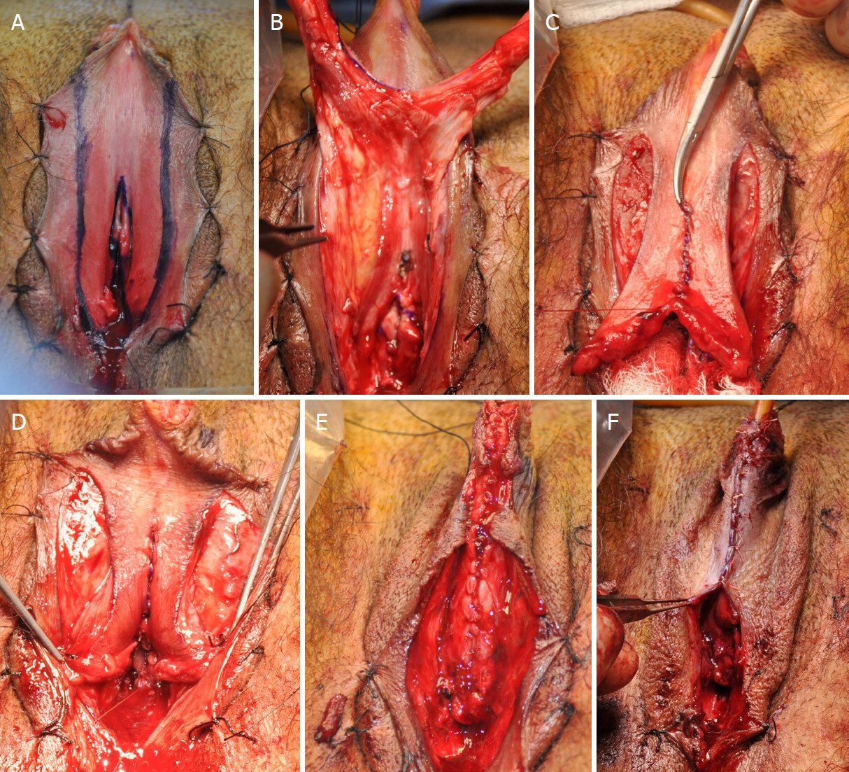 Metoidioplasty using labial advancement flaps for urethroplasty